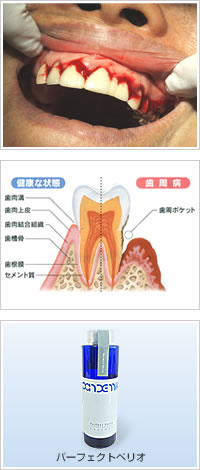 歯周病写真